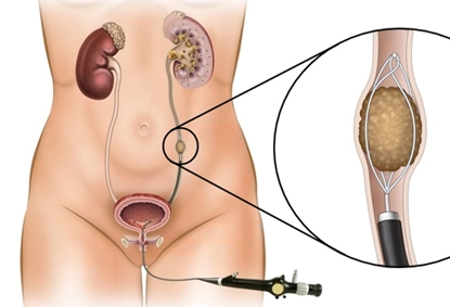 Ureteroscopy (URSL) Cost in Pune: What Affects the Pricing?